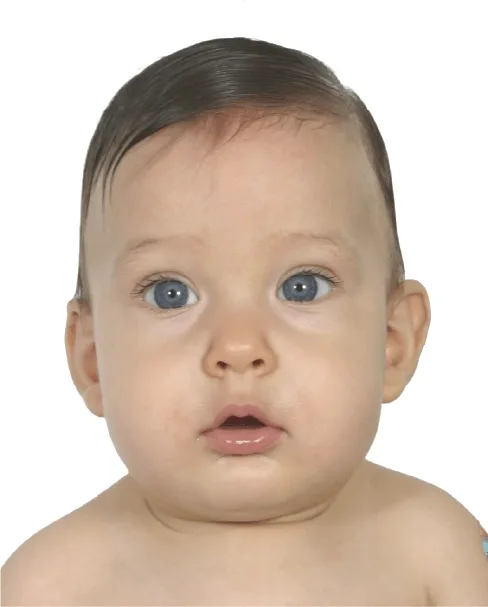 Scaphocephaly