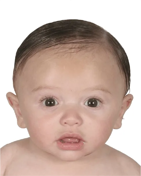 Brachycephaly