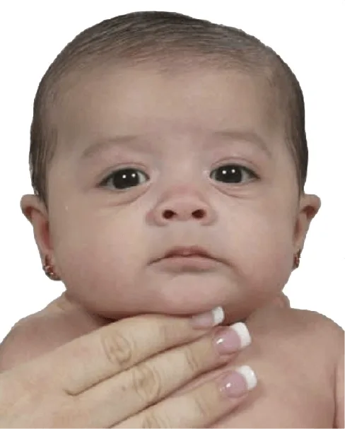 Plagiocephaly