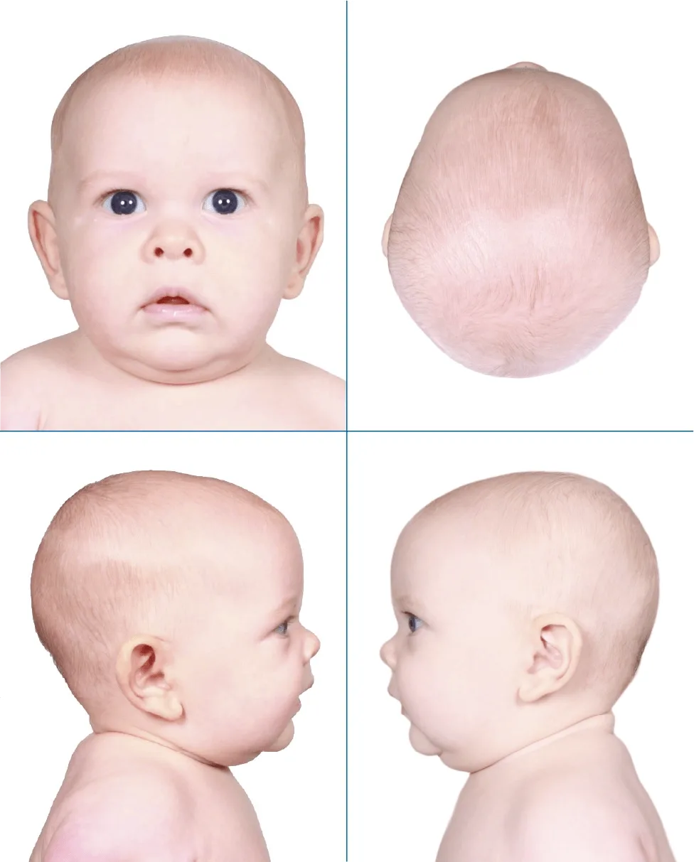 Normal head shape 3 months