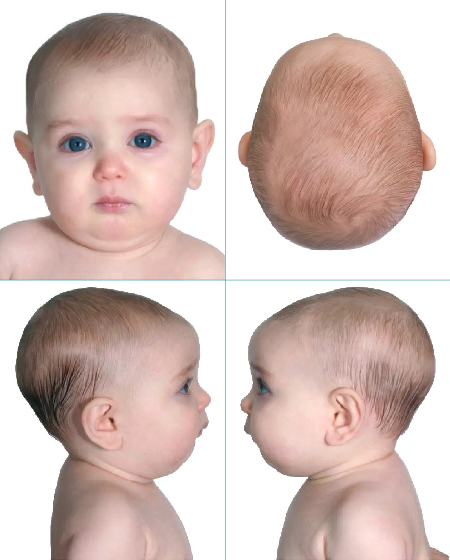 Normal head shape 6 months
