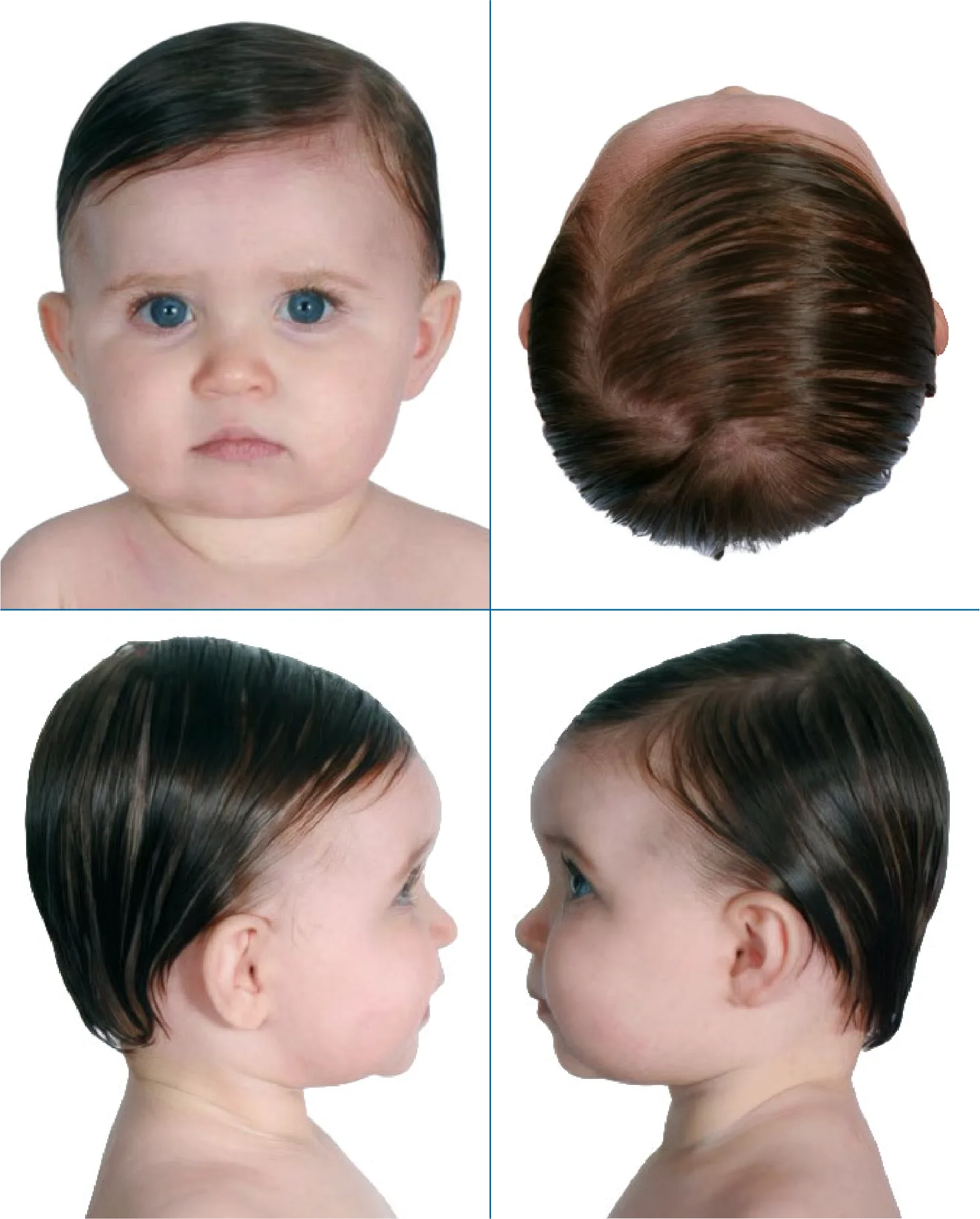 Normal head shape 9 months