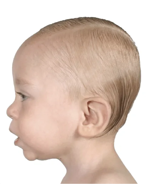 Scaphocephaly