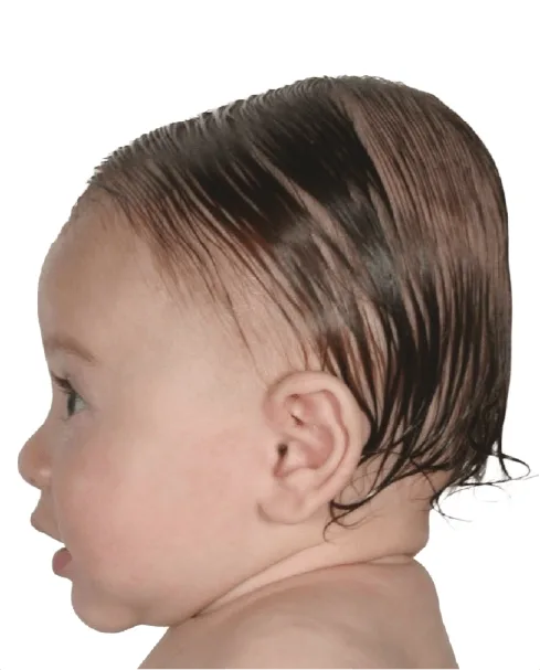 Brachycephaly