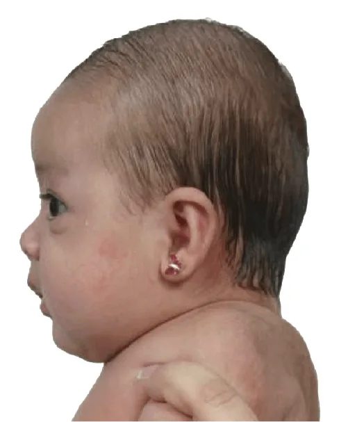 Plagiocephaly