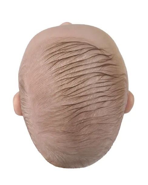 Scaphocephaly