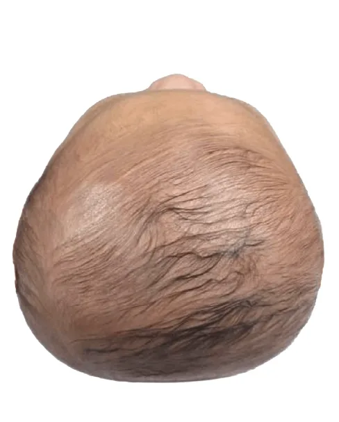 Brachycephaly