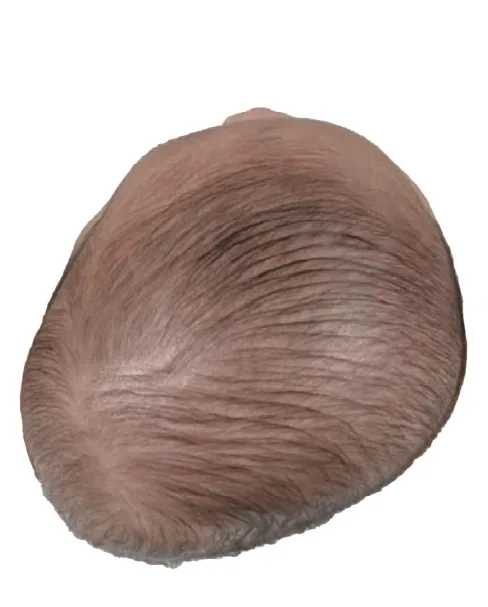 Plagiocephaly
