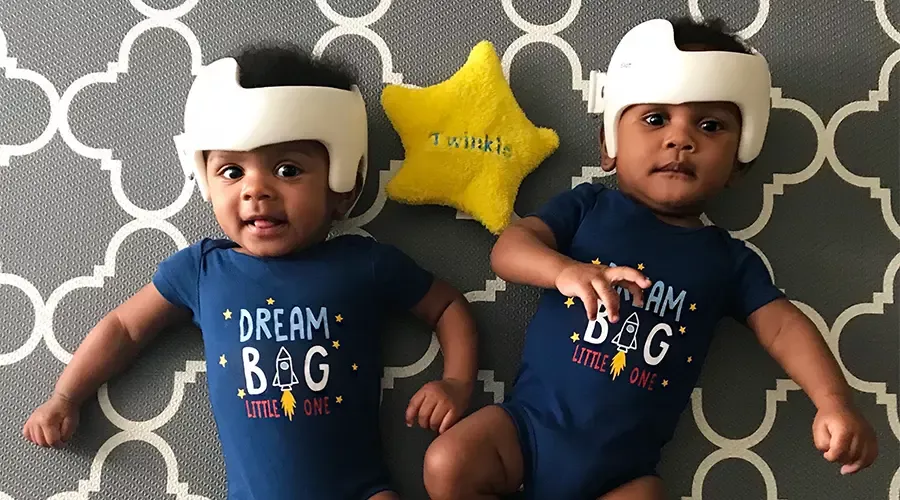 Baby 2024 helmet therapy