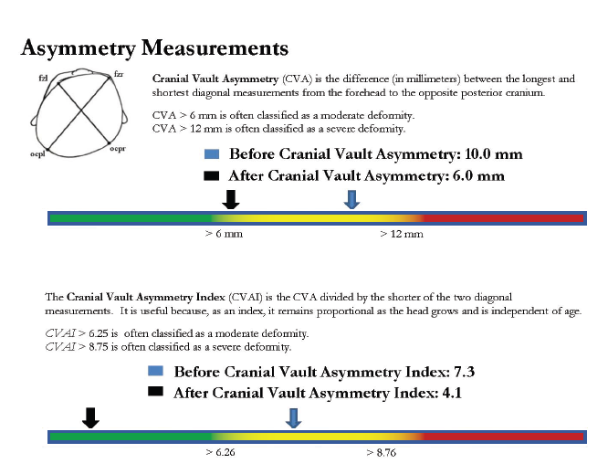 way to diagnosis plagiocephaly using cranial vault asymmetry