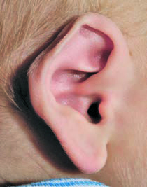 Prominent Helical Rim At Home Assessment Ear Shapes | Cranial Technologies