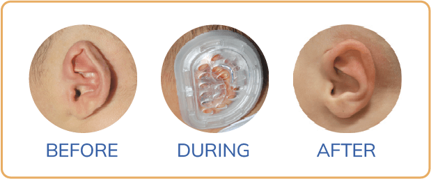 Before and after ear molding newborn results