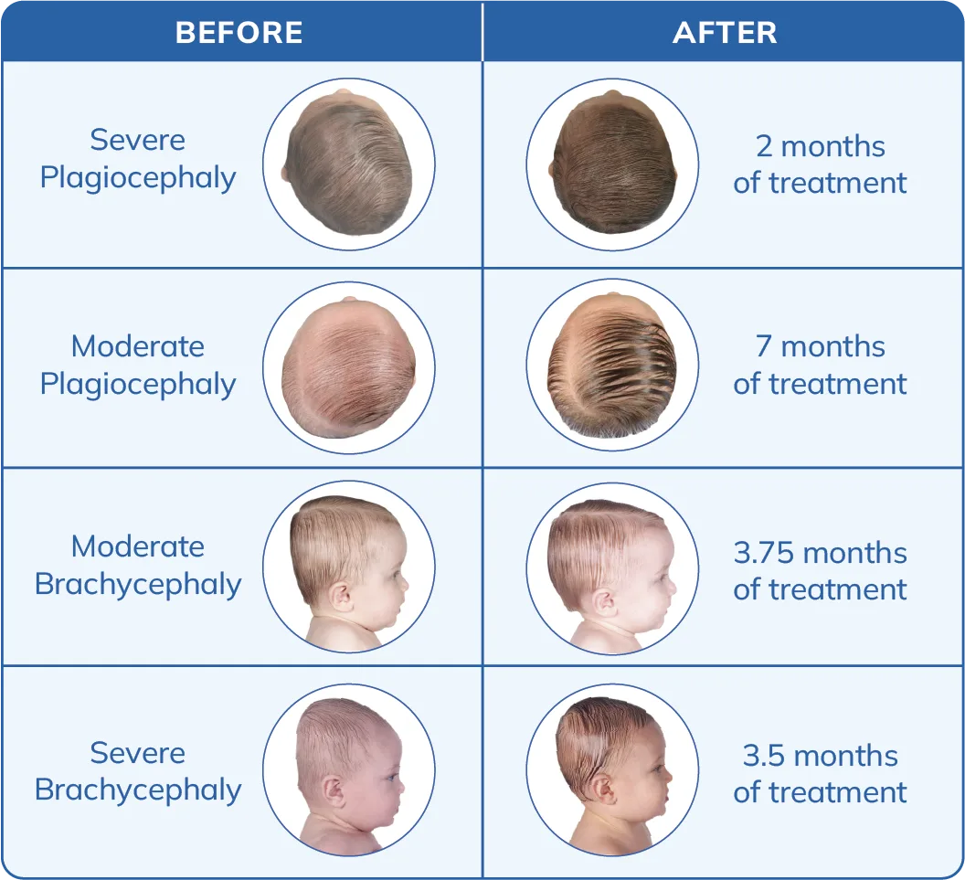 Head shape progress over a DOC Band treatment cycle