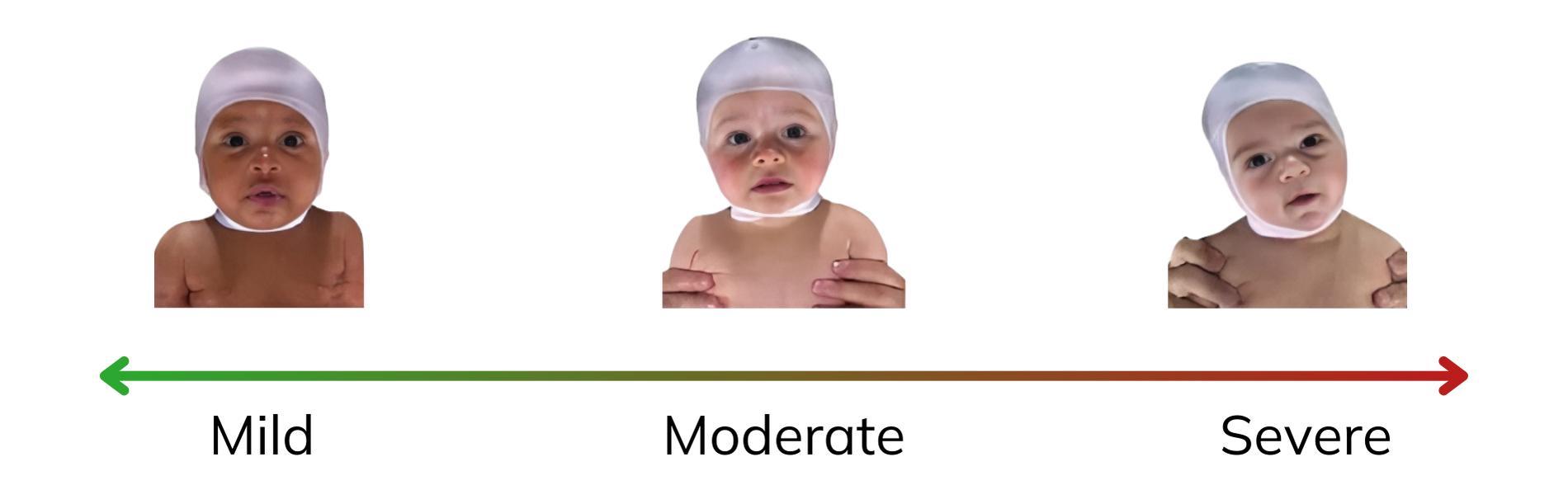 Graph showing severity levels of infant torticollis, indicating varying degrees of neck tilt and potential impact on development.