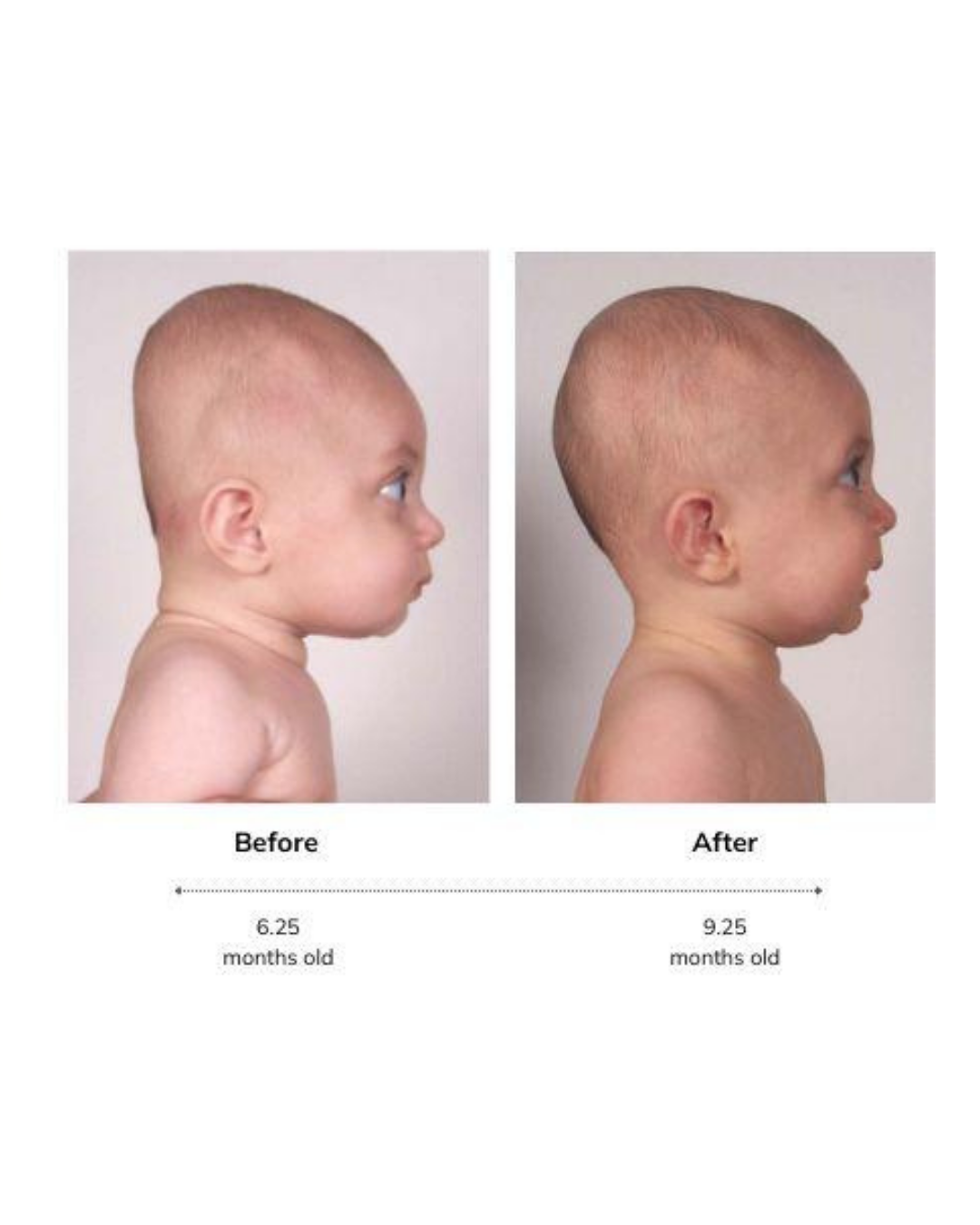 Brachycephaly and torticollis treatment results
