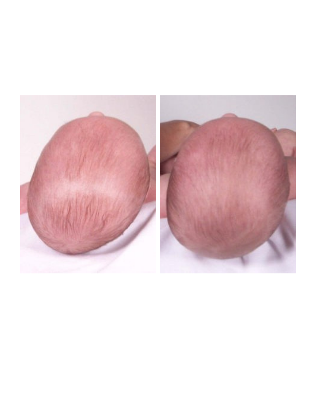 Severe plagiocephaly treatment results