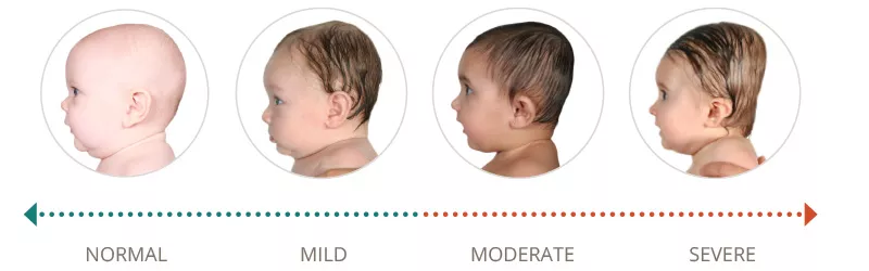 Plagiocephaly mild 2024