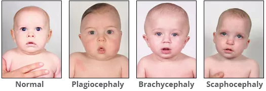Head shapes comparing normal to plagiocephaly from the frontal view