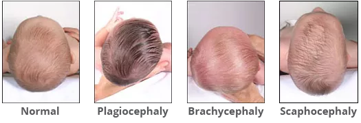 Head shapes comparing normal to plagiocephaly from above