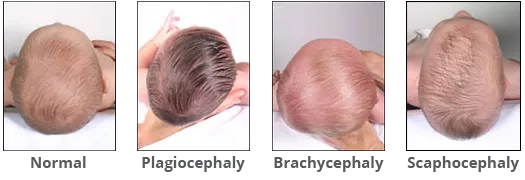 Plagiocephaly head best sale shape