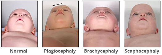 Head shapes comparing normal to plagiocephaly from below