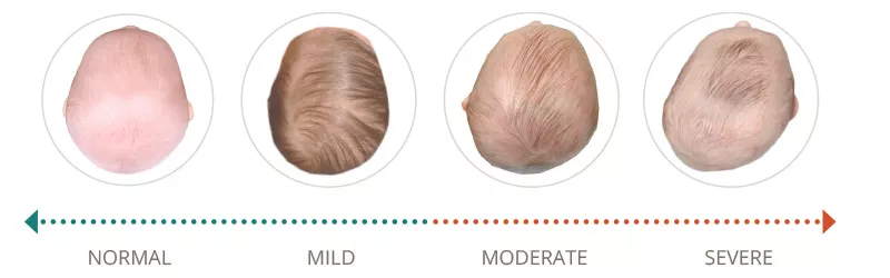 Severe plagiocephaly deals