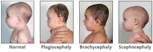 Head shapes comparing normal to plagiocephaly from the profile view