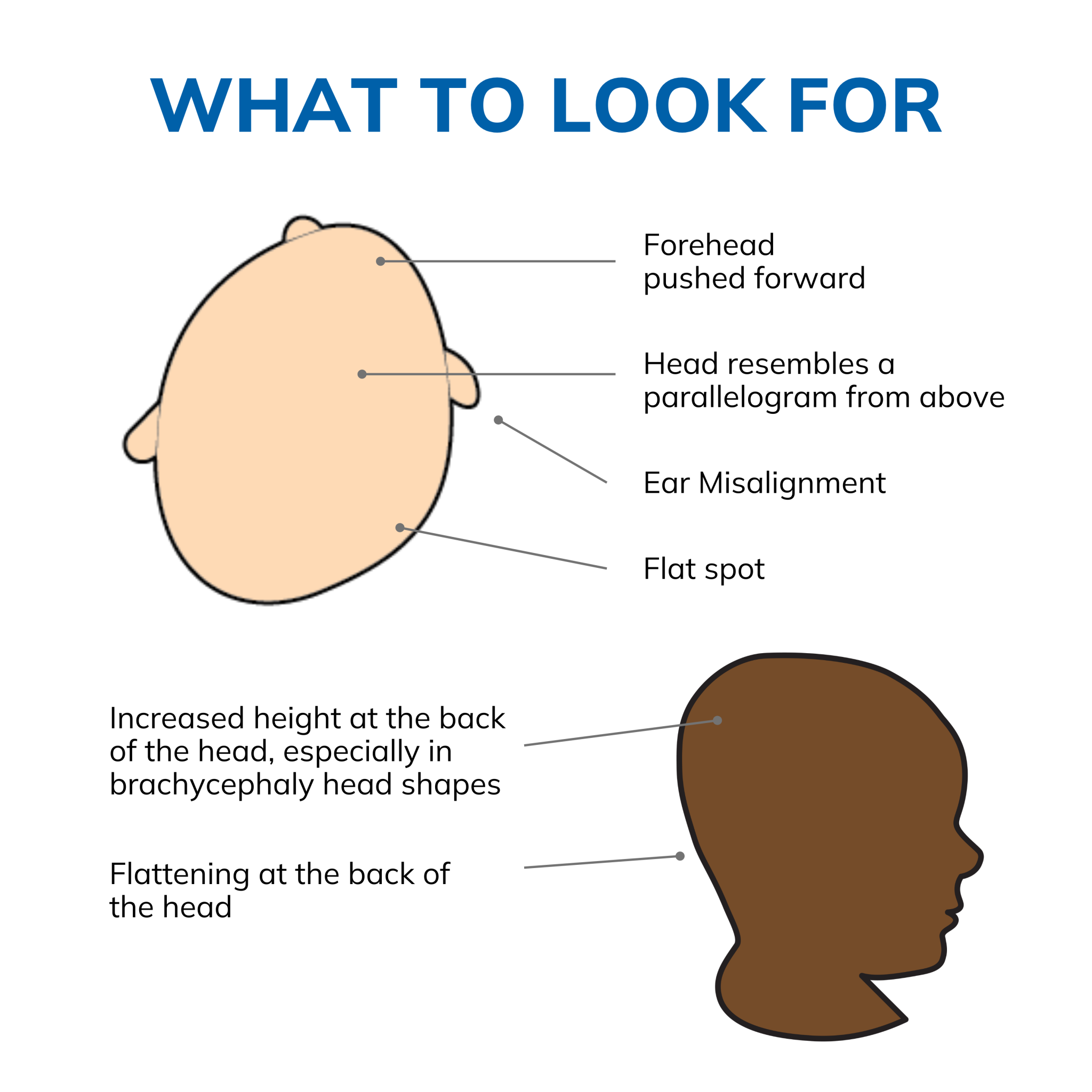 plagiocephaly head shape comparison chart