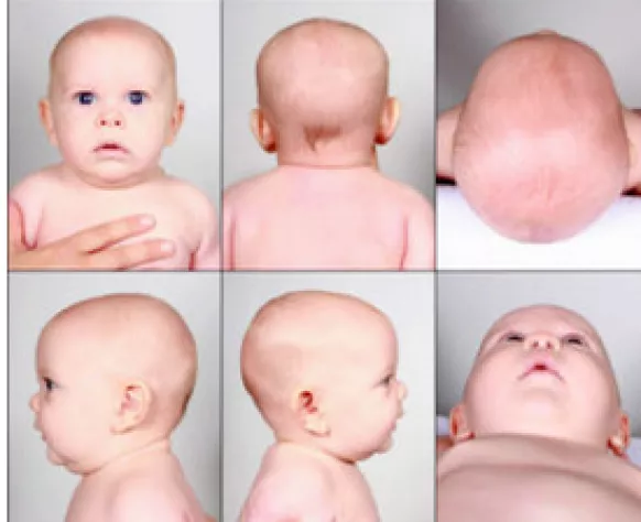 Normal head shape — 3 months old