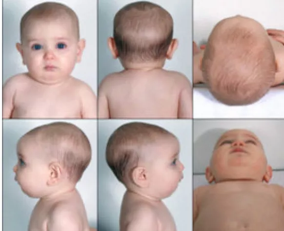 Head shape of deals newborn