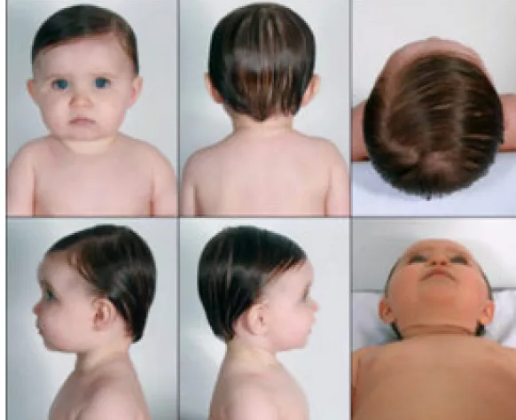Mild flat head hot sale baby