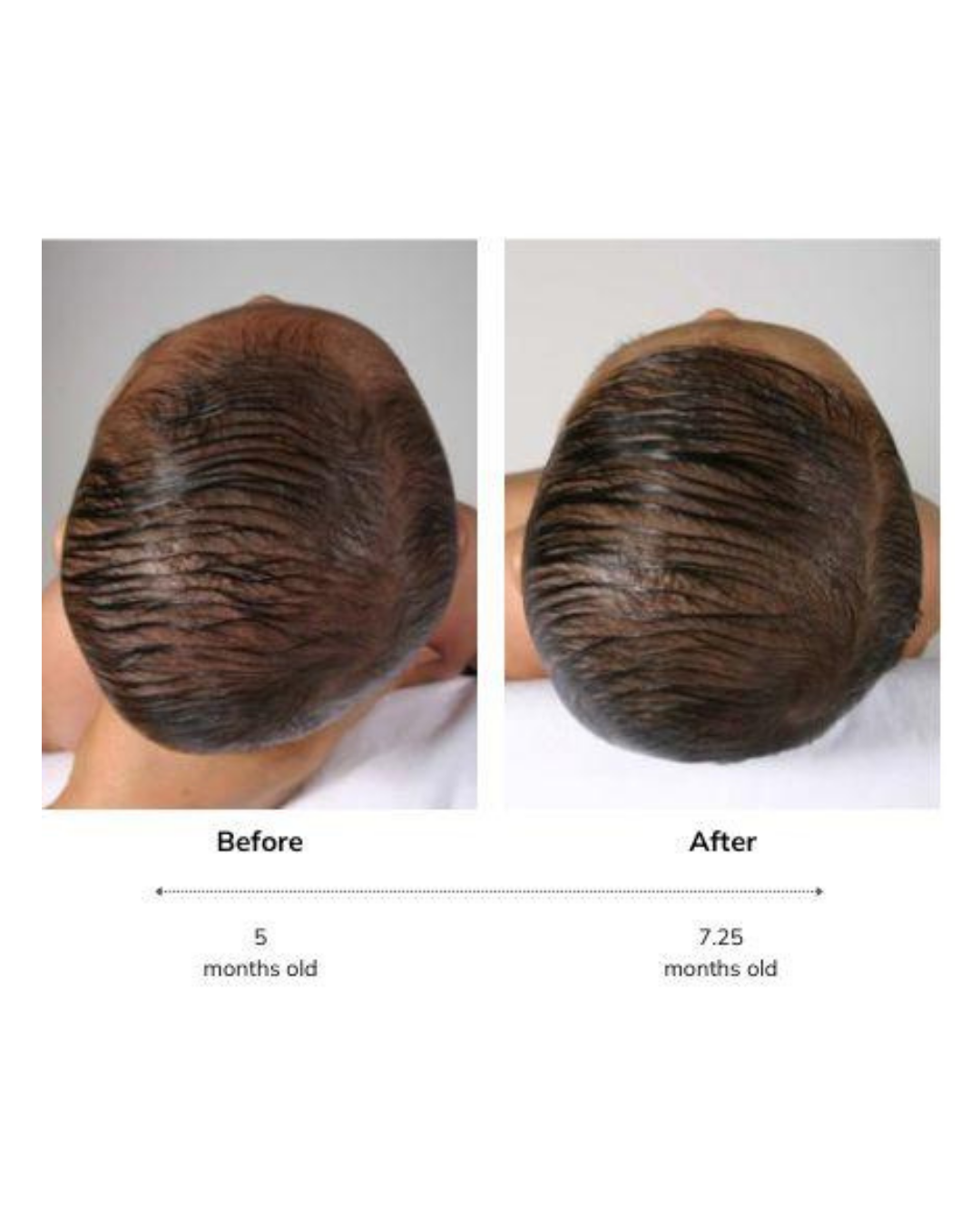 Before and after plagiocephaly treatment with Doc Band