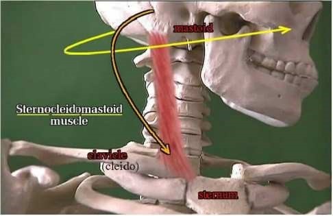 graphic showing how the Sternocleidomastoid muscle is affected by torticollis