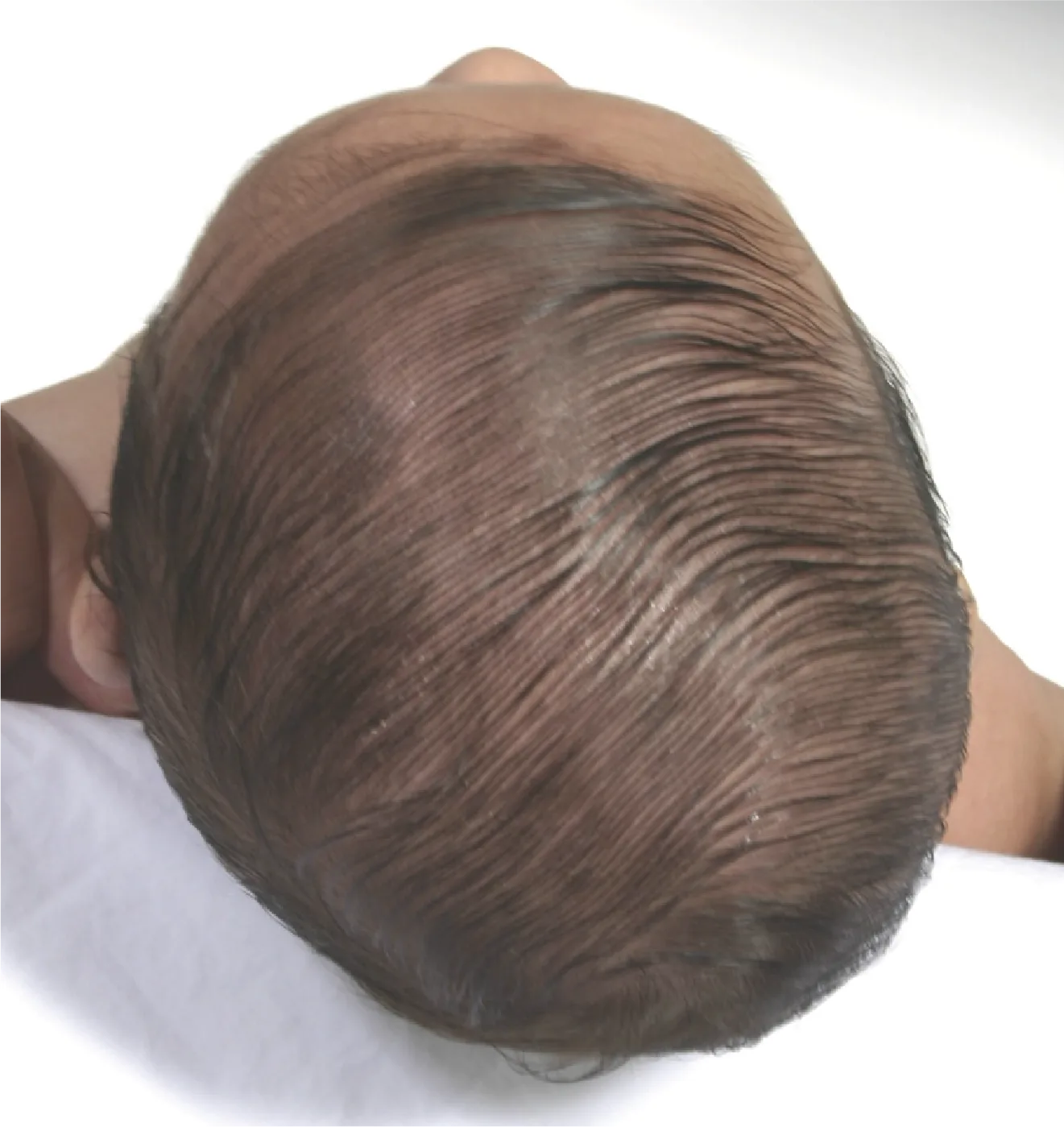 Forma de la cabeza del paciente antes del tratamiento con DOC Band