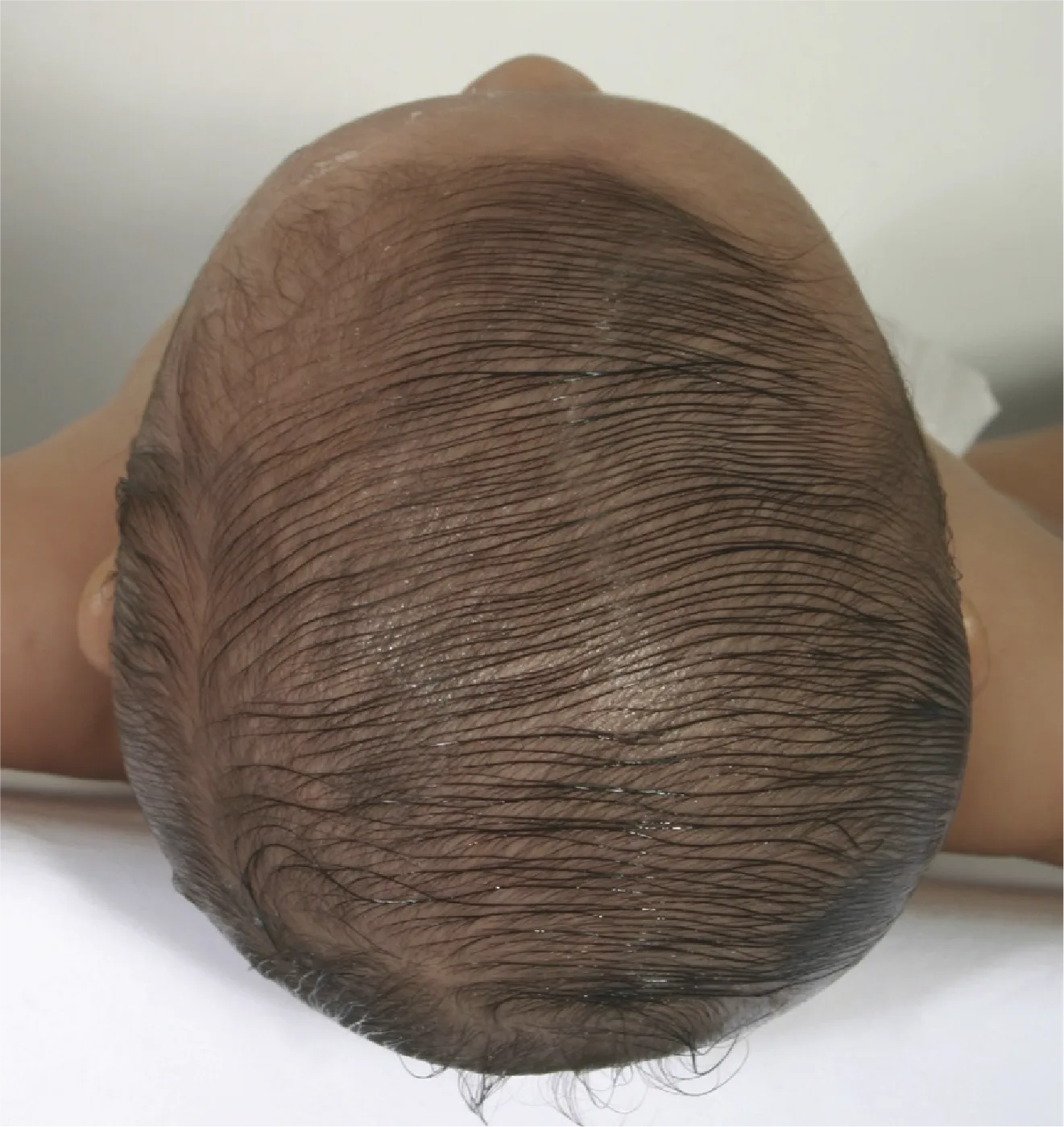 Forma de la cabeza del paciente tras el tratamiento con DOC Band